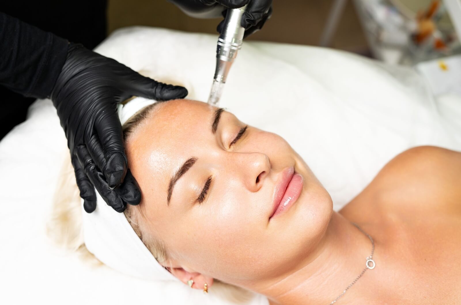 a person is undergoing a microneedling treatment to maintain their skin health.