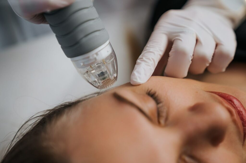 a person is undergoing a microneedling treatment for their skin concerns