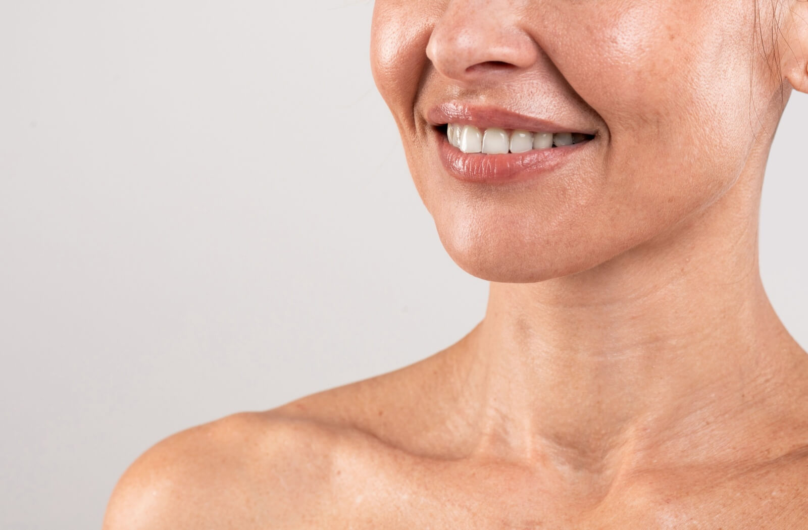 a person smiling with laigh lines that can be treated in various ways.