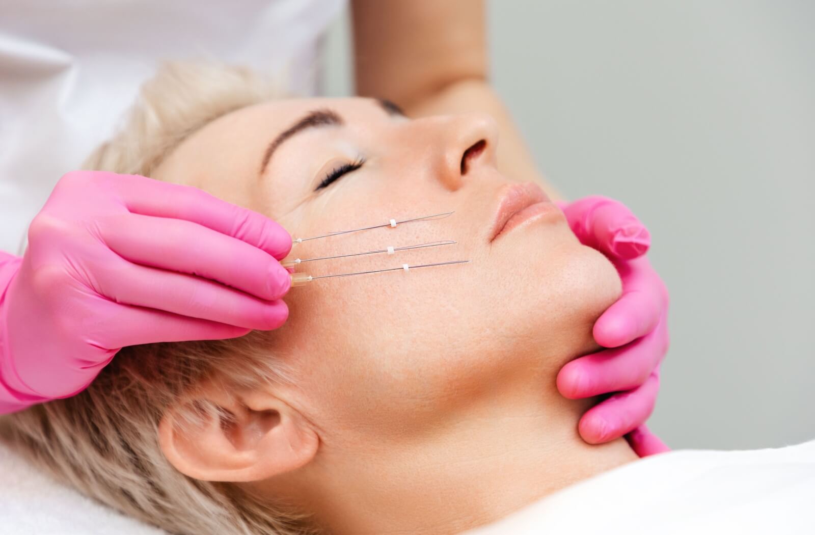 A person lays in a treatment suite as a nurse holds 3 PDO thread applicators to their face.