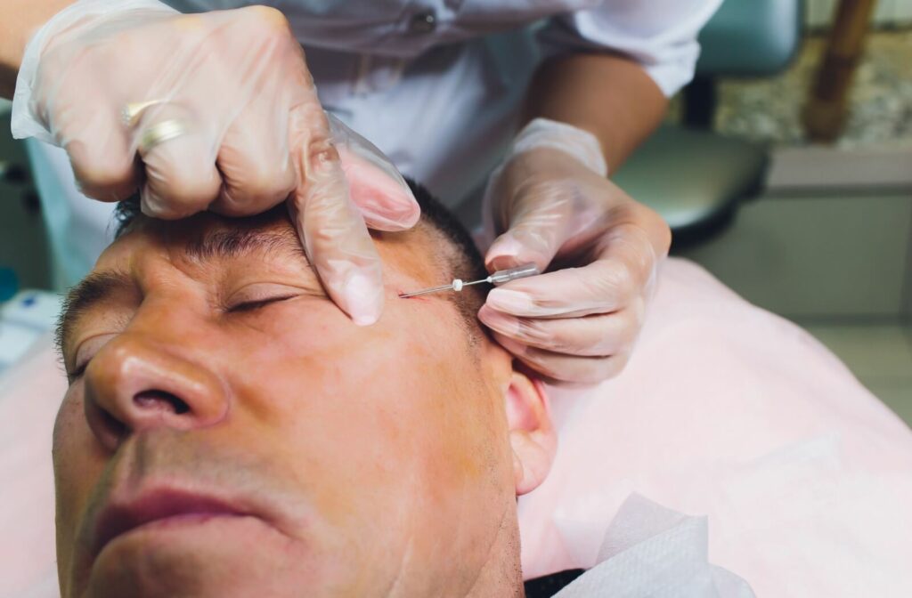 A skilled practitioner applies PDO threads to a patients temple.