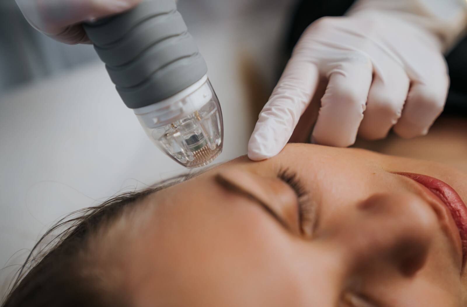 Microneedle RF lifting procedure on a client.