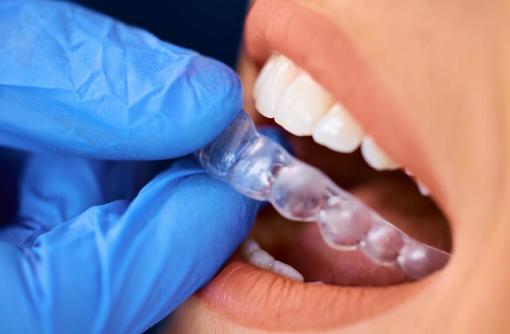 A close-up of a dentist inserting an Invisalign dental aligner into a patient's mouth.