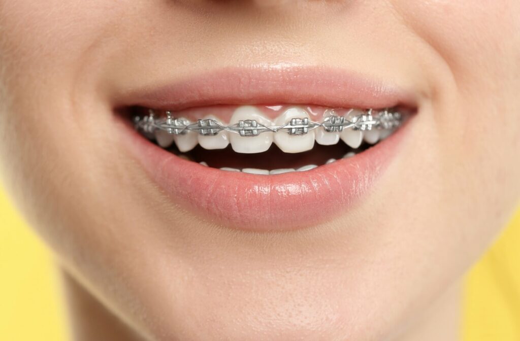 A close-up image of someone smiling with traditional metal braces.