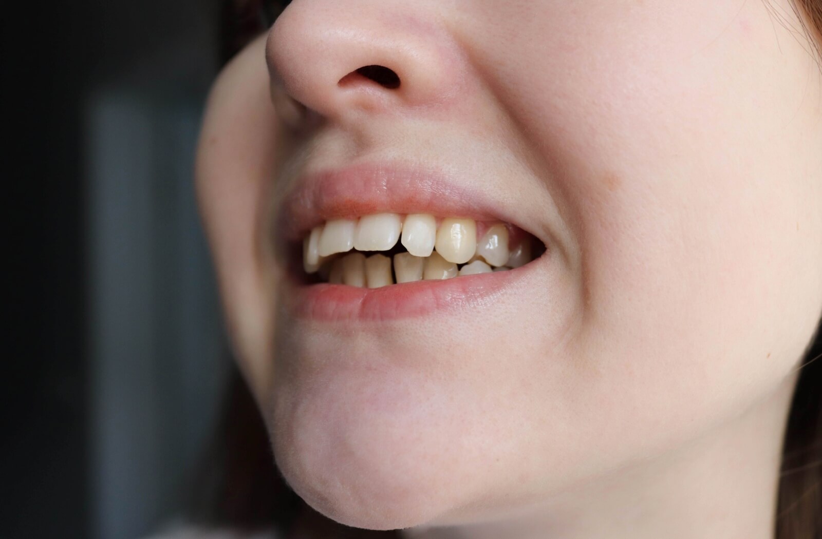 A close-up of a person's smile showing misaligned teeth and an overbite, used to illustrate how Invisalign treatment can correct bite issues.
